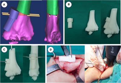 Design and application of a novel 3D printing digital navigation template for cubitus varus deformity in children